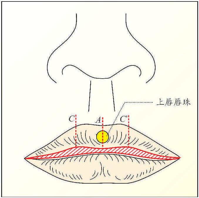 二 手術(shù)方法